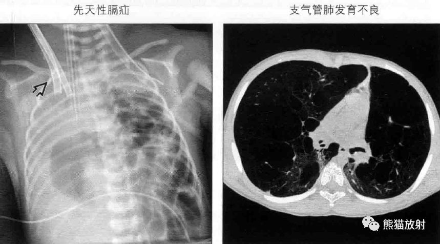 孕妈助孕服务生的婴儿肺部有炎症怎么办，孕妈助孕服务生的婴儿肺部发炎怎么办